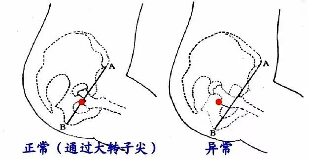 nelaton线图片图片