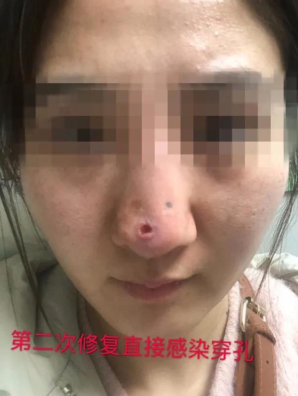 整容变毁容!河南濮阳一女子做隆鼻,最后化脓溃烂穿孔