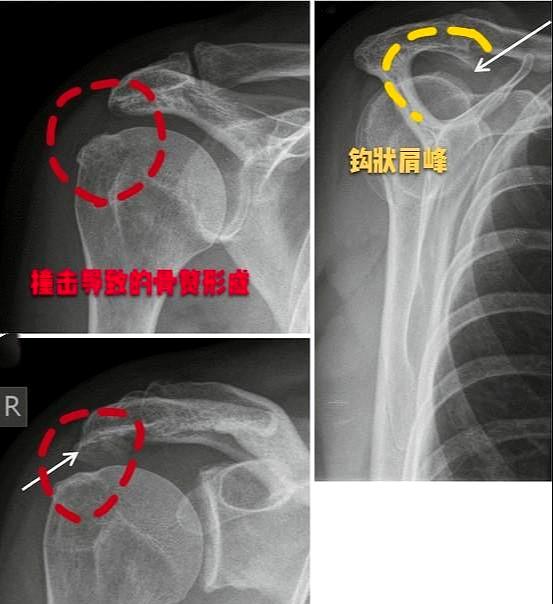 长期肩膀疼痛,反复治疗也不好,问题在哪儿?医生帮您分析下!