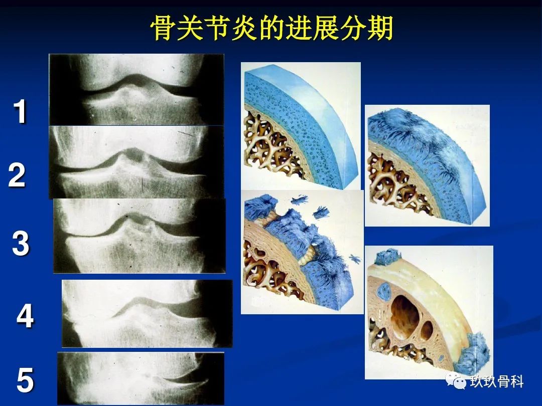 膝关节骨性关节炎的阶梯治疗