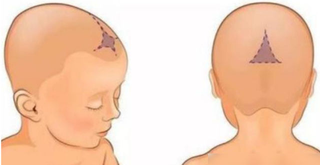 婴儿方颅症状图片