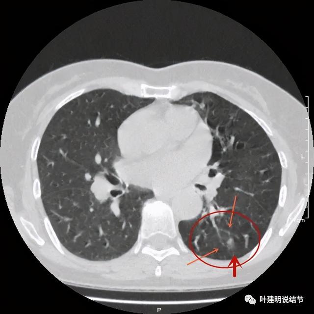 部分实性结节 来自网易
