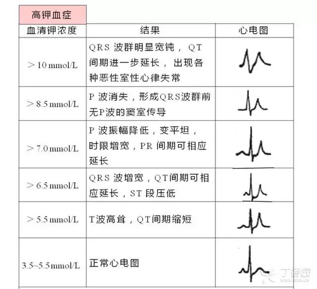 低钾血症的心电图特征图片