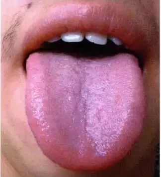 巧用舌诊,一眼就能看出疾病的5个要点