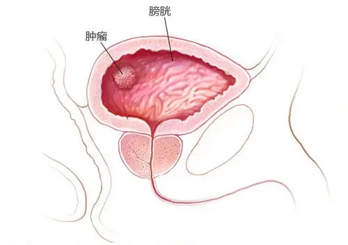膀胱癌的早期症状图图片