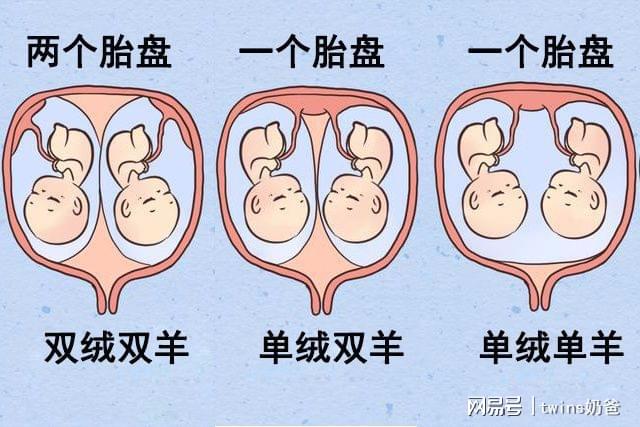 孕期双胞胎的几种类型