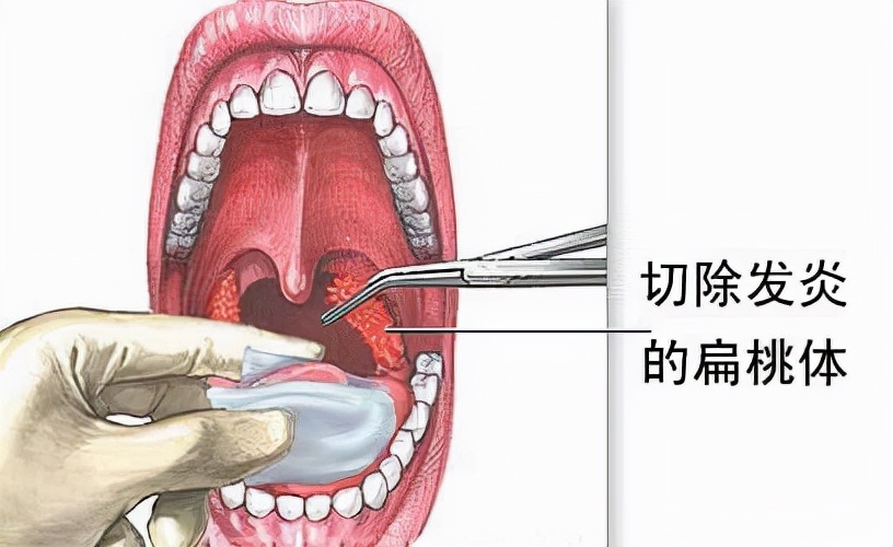 扁桃体分度图图片