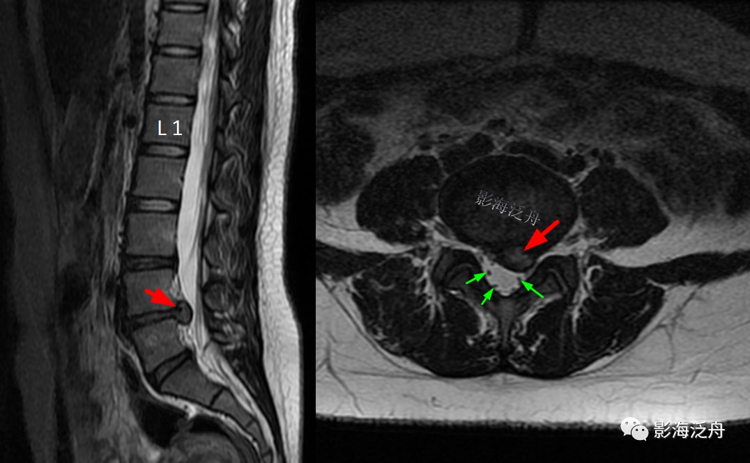 l4s1椎间盘突出图片