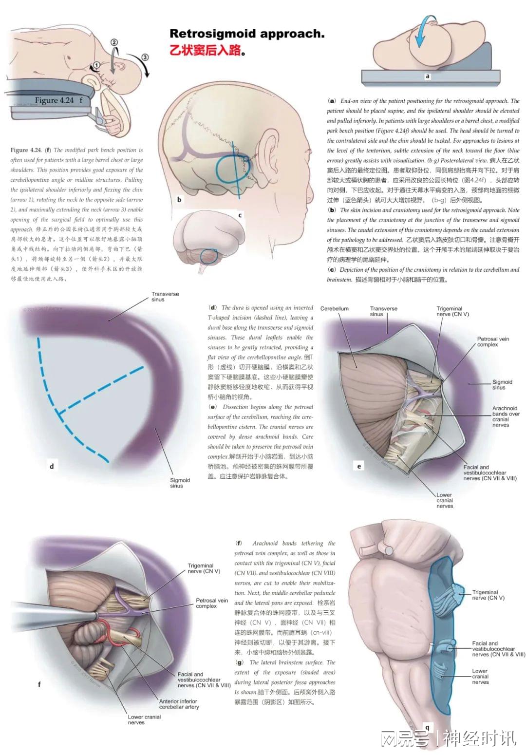 乙状窦后入路切口设计图片