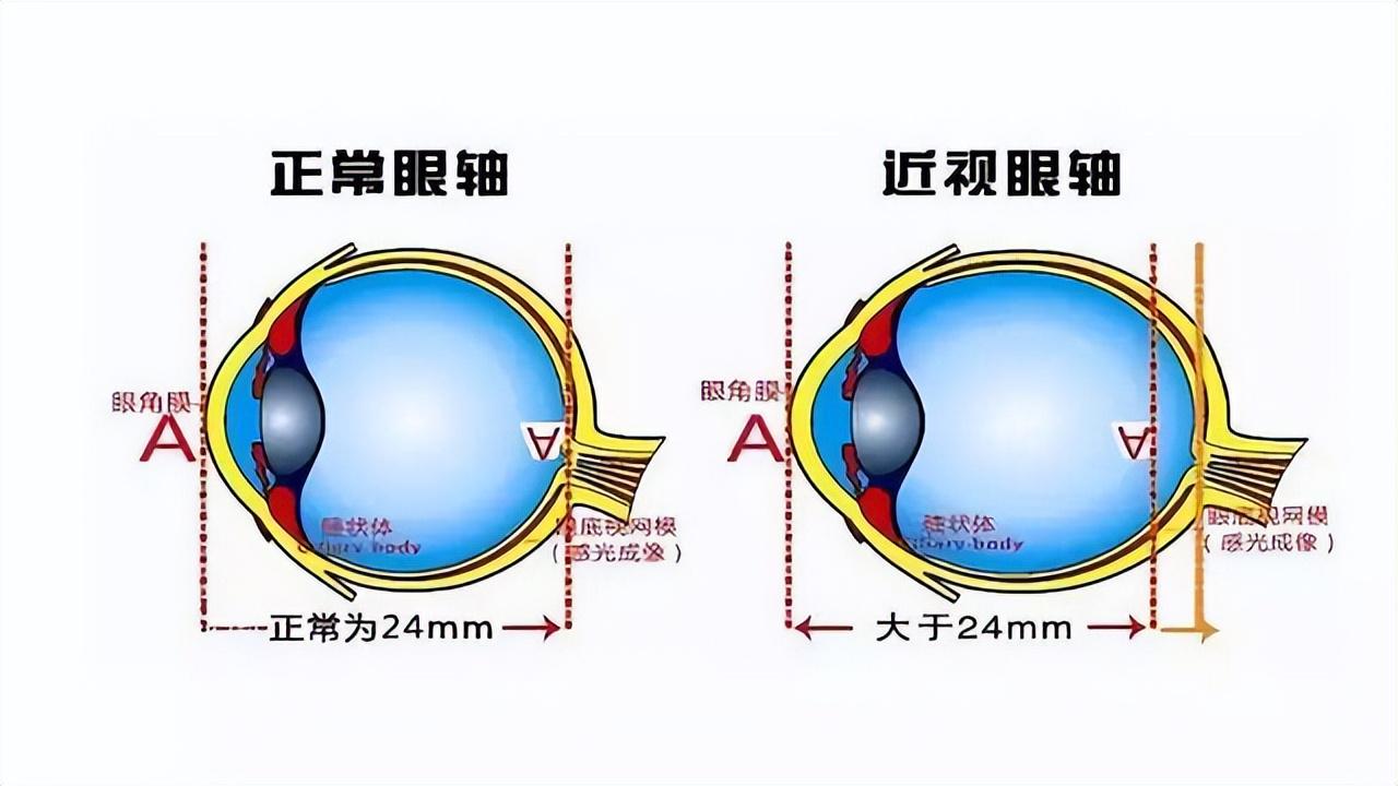 5岁孩子近视1000度 最伤孩子视力的不是手机