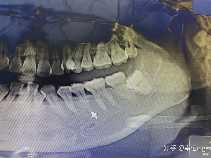 拔智齿牙多少钱（拔一颗智齿，最贵要多少钱）-图2