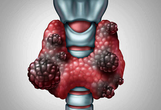 甲状腺肿瘤图片