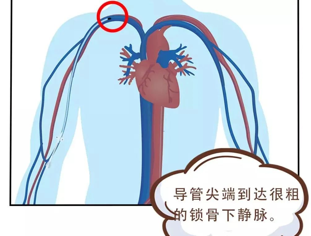 锁骨下动脉置管图片