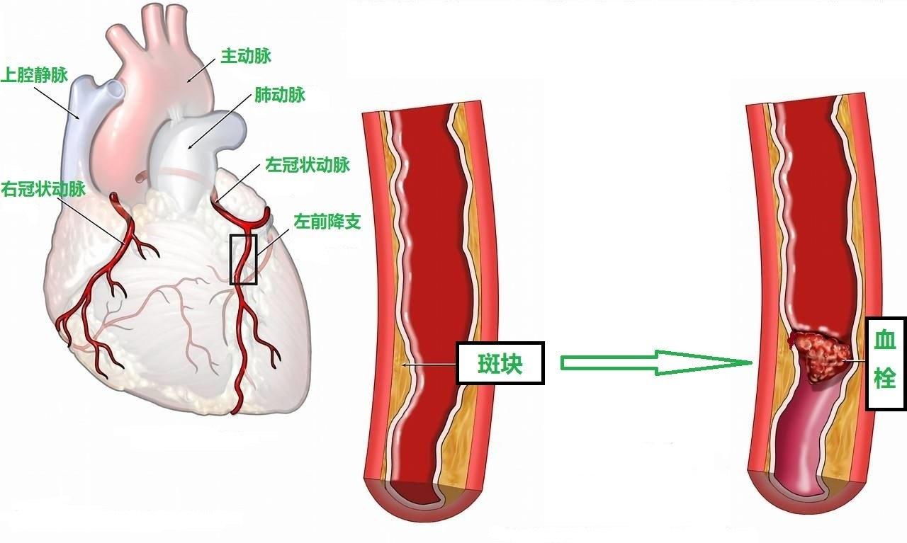 冠脉的位置图图片