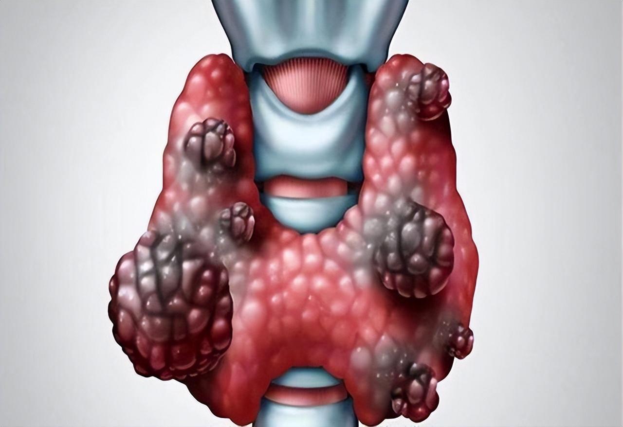 甲状腺肿是什么意思图片