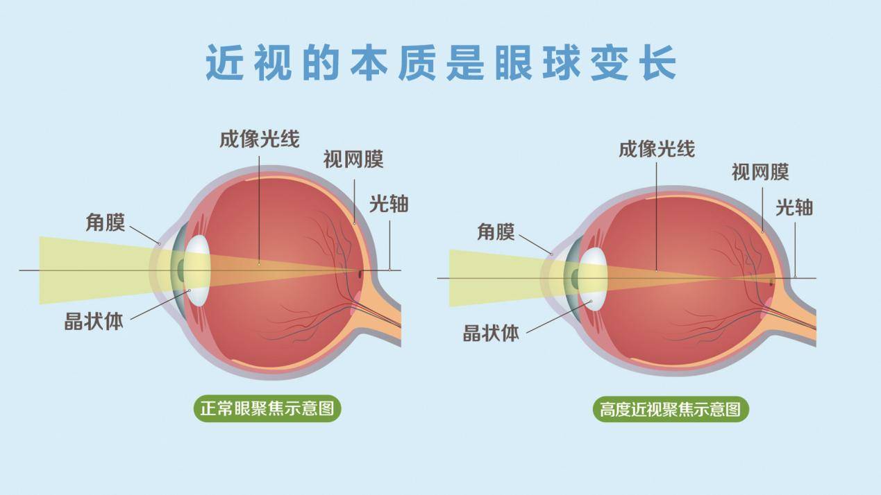 眼睛近视分析图图片