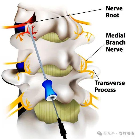 不开刀治疗腰椎间盘突出症