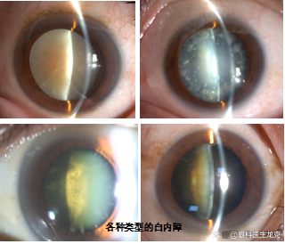 白内障变厚,导致青光眼急性发作