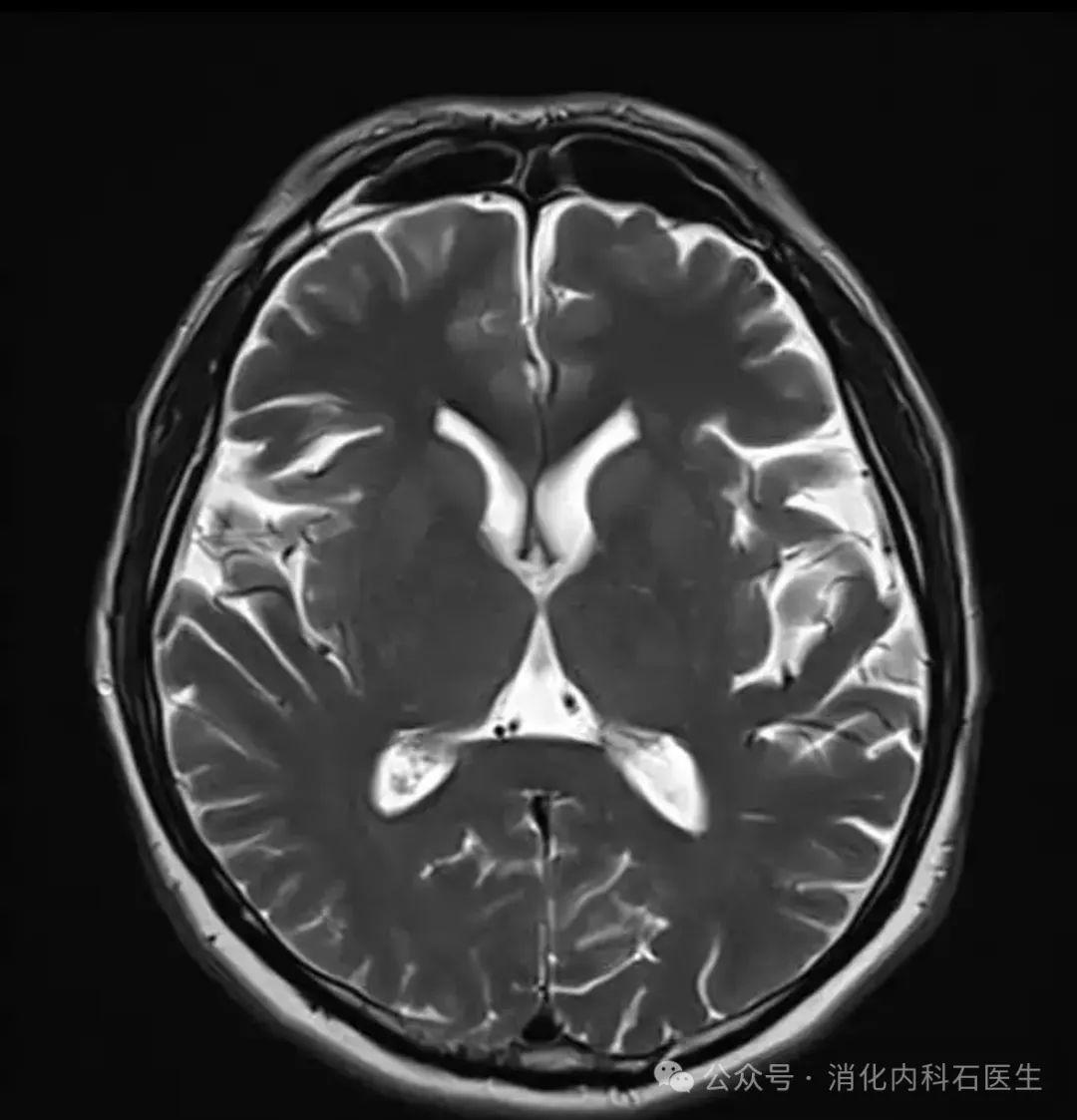 脑瘤核磁共振图片图片