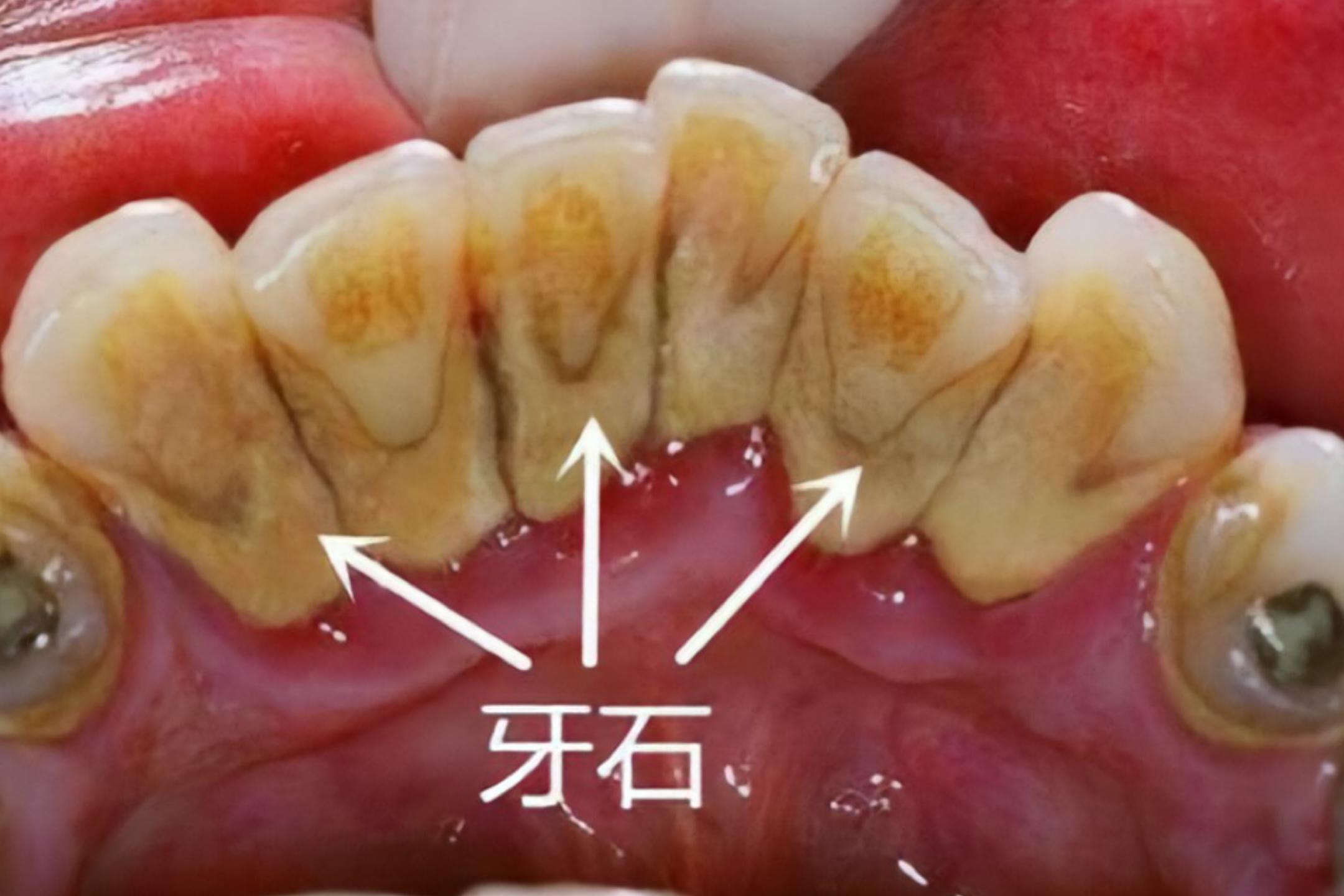 牙结石又黄又厚?不用洗牙牙石刷刷掉