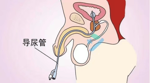 院 男患者卧床难换尿管