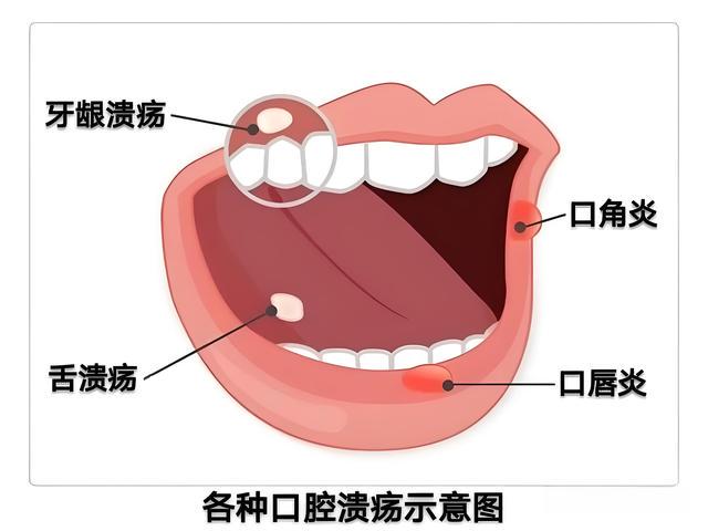 反复性口腔溃疡是什么原因引起的?