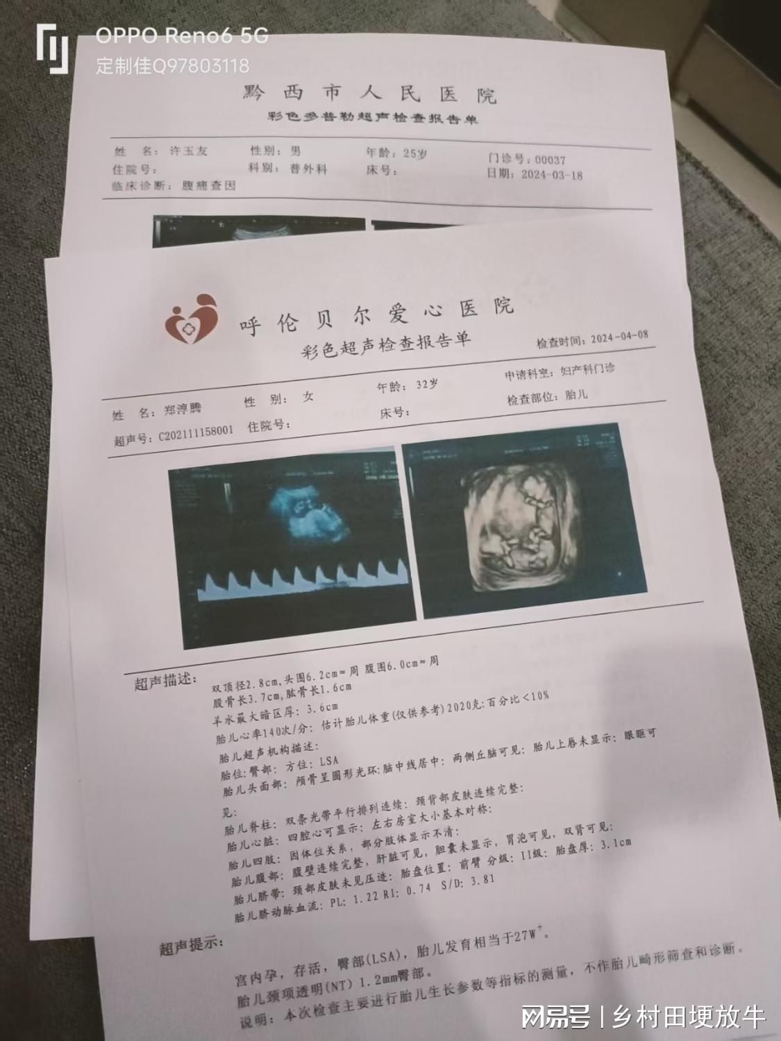 怀孕早孕病历单入院单住院病危B超2周3周4周5周6周怀孕血检病历单