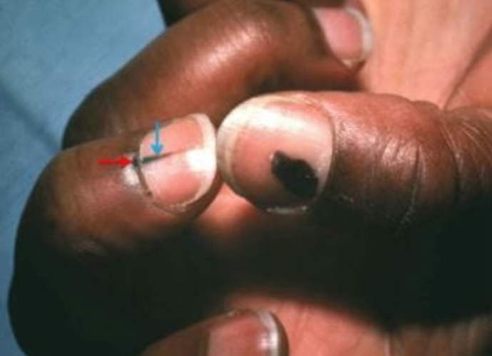 △肢端雀斑样痣黑色素瘤。