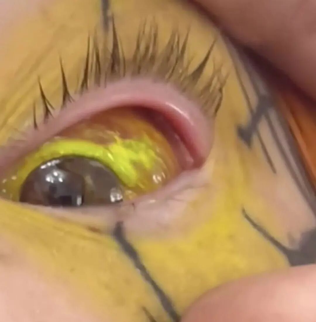 （眼部出现并发症）