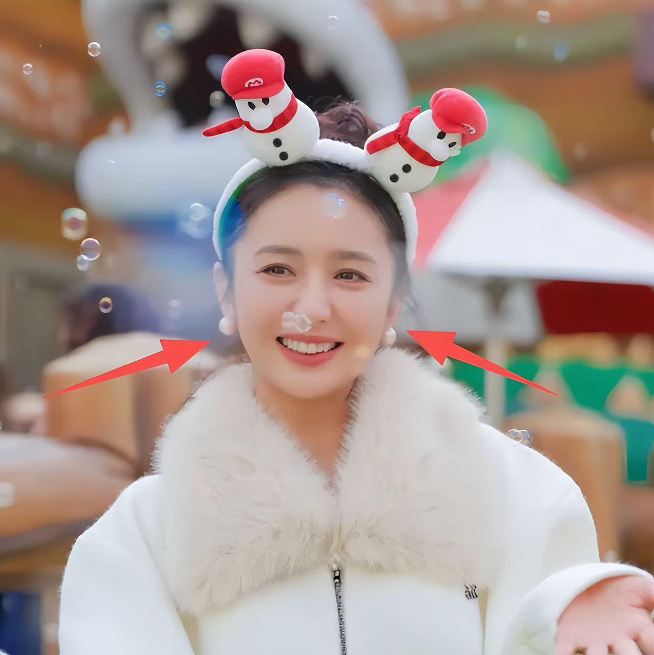 42岁佟丽娅在美国过元旦！脸浮肿眼角皱纹多，发际线植发痕迹明显