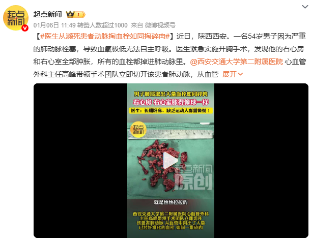 血管里取出“碎肉”是血栓？医生：身体出现这4个信号，千万别拖