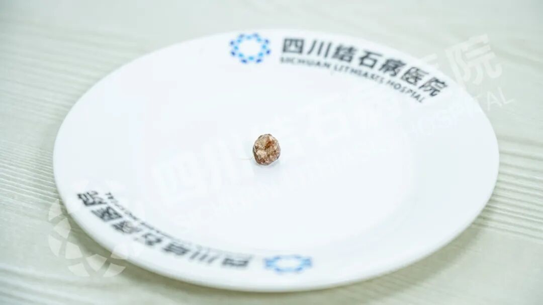 △ 从患者胆囊管内取出的结石