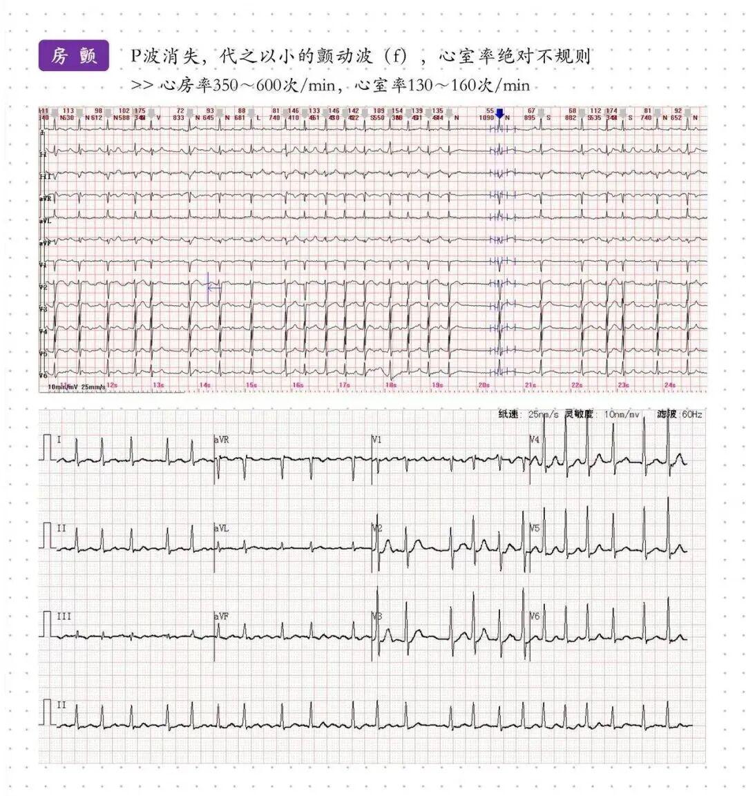 超全！各种心电图和对应疾病归纳总结，快收藏！