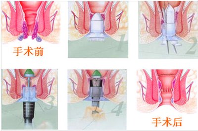 混合痔疮环切手术图解图片