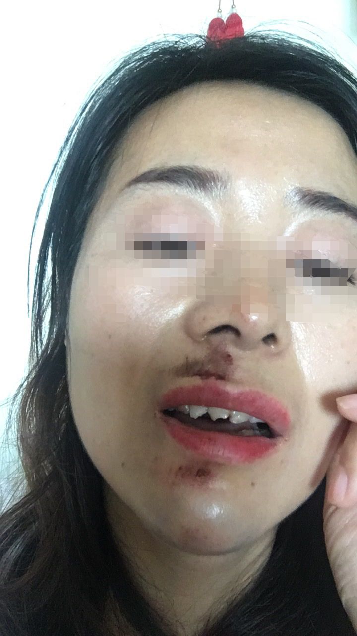 水泥减速带成拦路虎女子骑行摔破相起诉维权