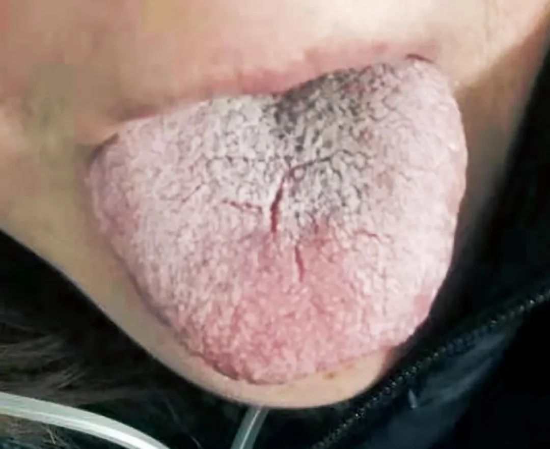 新冠肺炎的舌苔图片图片