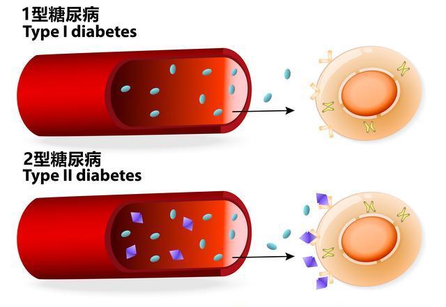 醫學科普|防不勝防的1型糖尿病,和2型有什麼區別?